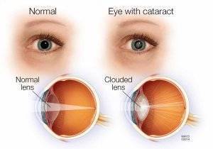 Как лечить катаракту без операции народными средствами отзывы кто вылечился