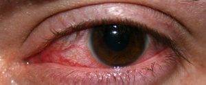 Какой вред наносят линзы для глаз