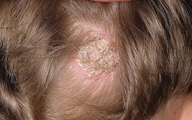 Грибок кожи головы: причины, признаки, диагностика и лечение. много фото