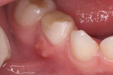 5 опасных причин появления белых язвочек во рту