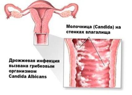 Симптомы и лечение кольпита (неспецифического вагинита)