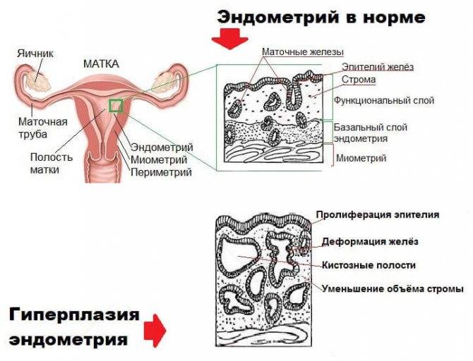 Атрофия эндометрия – норма в менопаузе, патология, требующая лечения, в репродуктивном возрасте