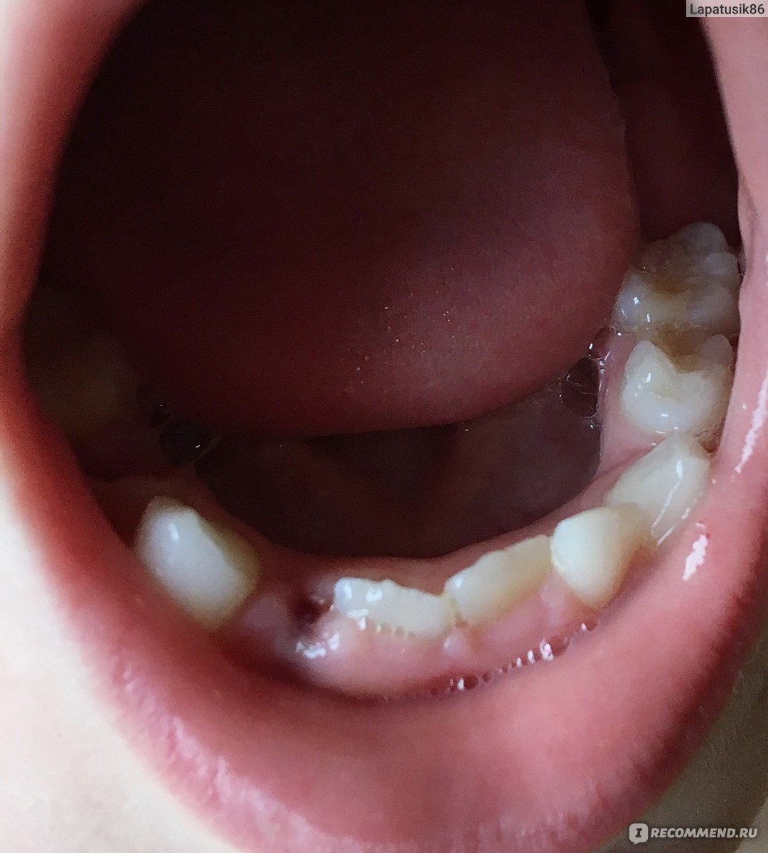 Анестезия при удалении зубов с помощью скандонеста