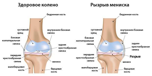 Повреждение мениска коленного сустава - что делать?