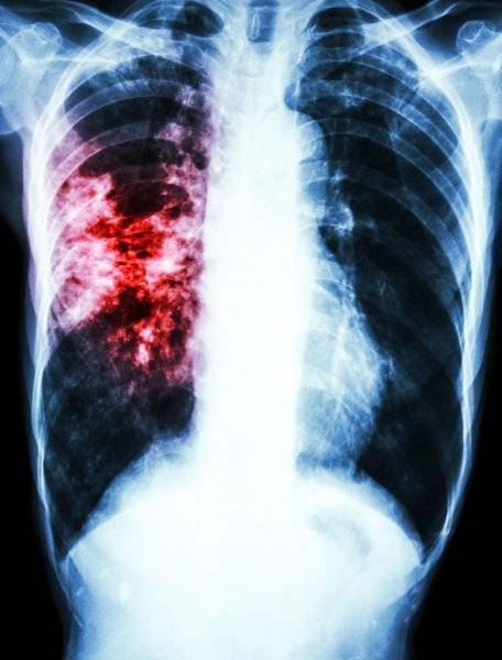 Крупозная пневмония — медицинская википедия