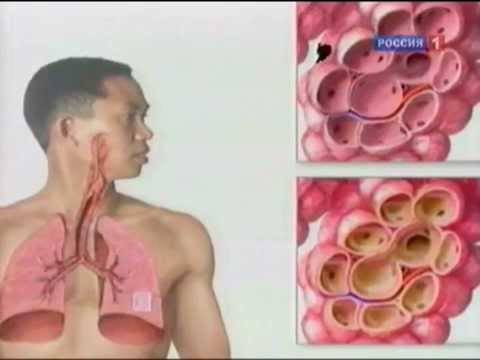 Пневмония: симптомы, признаки воспаления легких у взрослых, современные методы лечения