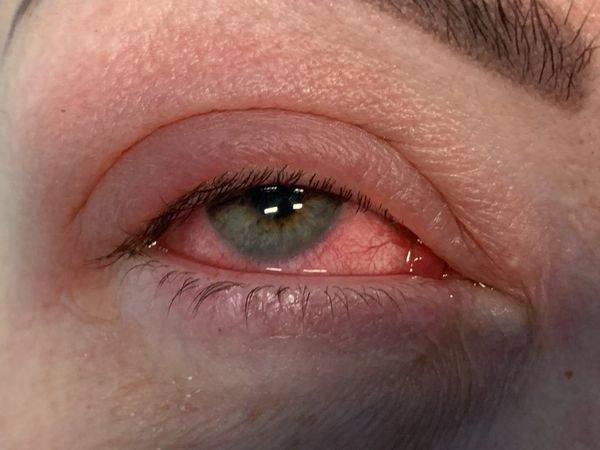 Что такое мейбомит глаза: причины и лечение