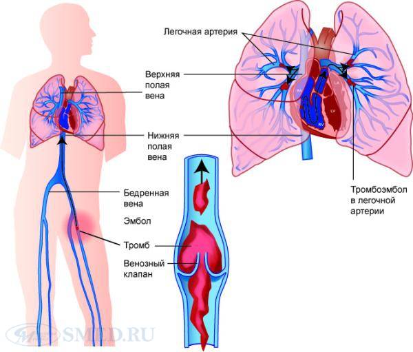 Тромбоэмболия легочной артерии – лечение, симптомы и диагностика