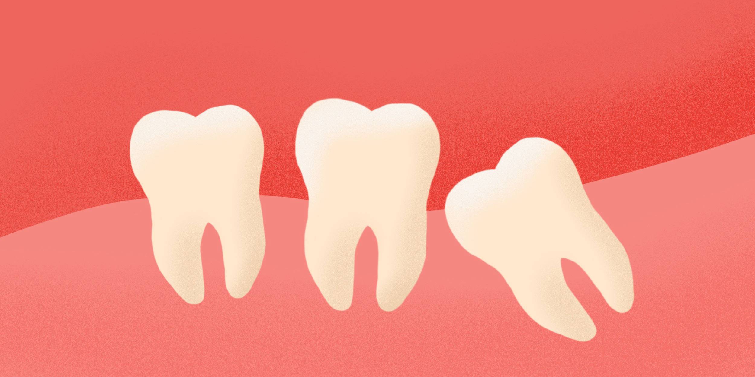 Зубы мудрости: особенности роста и удаления
