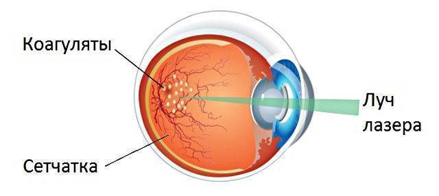Народные средства лечения тромбоза центральной вены сетчатки глаза