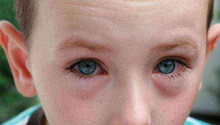 Детские капли для глаз от воспаления и слезотечения
