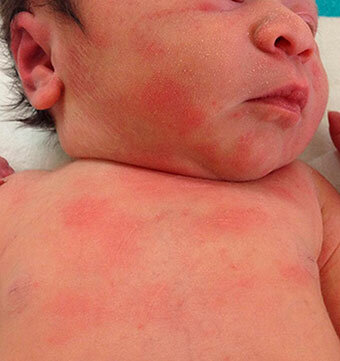 Себорейный дерматит у грудных детей и новорожденных