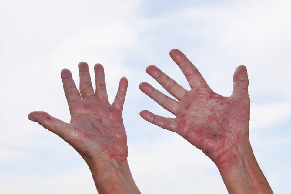 Грибок на руках: фото симптомов, начальная стадия, эффективное лечение