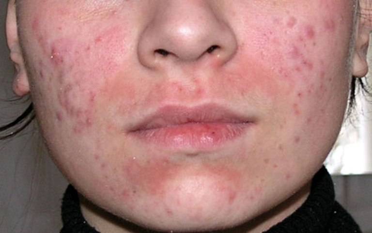 Аллергические прыщи на лице: причины, лечение, как быстро избавиться от аллергии в виде прыщей