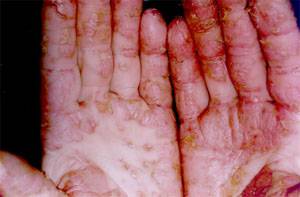 Грибок кожи: симптомы, виды, этапы возникновения и первые признаки. лечение и профилактика заболевания (85 фото + видео)