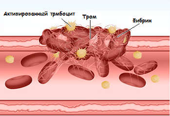 Выход клеток крови из костного мозга. синусоидальное дерево. неэффективность эритропоэза. неэффективный гранулопоэз.