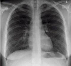 Виды рентгена при пневмонии у детей и примеры снимков