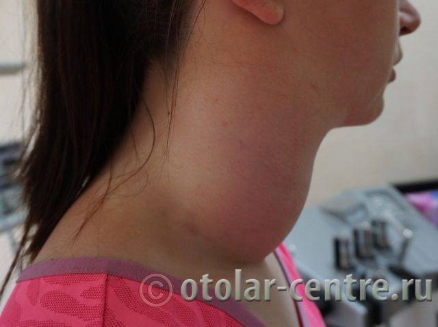 Об уплотнениях и шишках на лице под кожей: причины появления, способы избавления