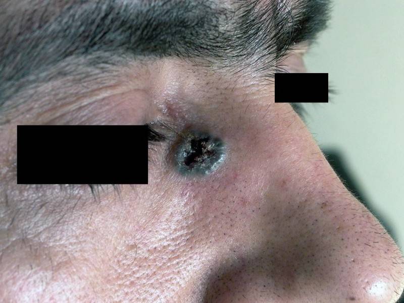 Симптомы и лечение базалиомы кожи, лица, носа