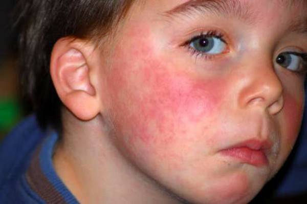 Может ли быть аллергия на гречку: причины, симптомы, лечение