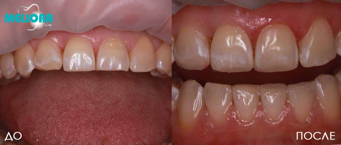 Методы восстановления зубной эмали