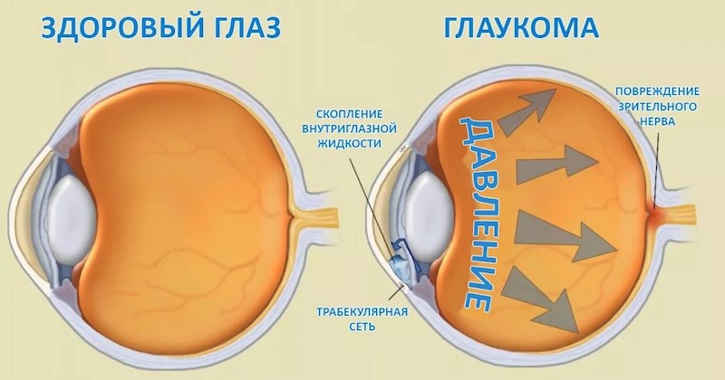 Глаукома - диагностика, лечение, профилактика и осложнения