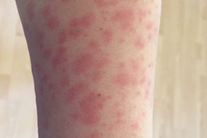 Виды, проявления и лечение токсико-аллергического дерматита
