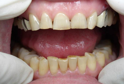 Как восстановить зубную эмаль дома стоматологические и народные методы