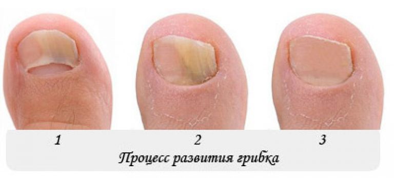 Грибок ногтей на руках: причины возникновения, симптоматика, традиционное и альтернативное лечение