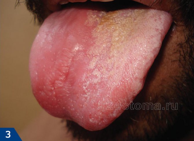 Грибок в носу: признаки и лечение