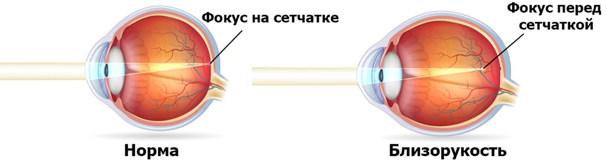 В какой части глазного яблока происходит фокусирование изображения у людей с нормальным зрением