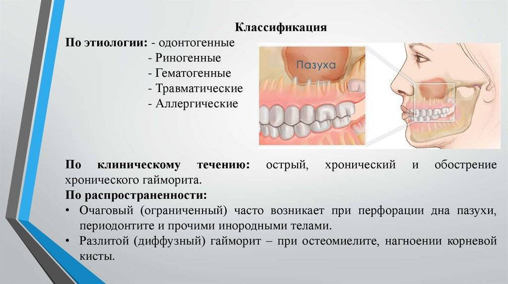 Одонтогенный гайморит презентация