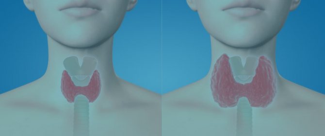 Способы лечения и последствия нарушения гормональной секреции щитовидной железы