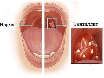Воспаление гланд и миндалин в горле у взрослых и детей: симптомы, причины, лечение, фото