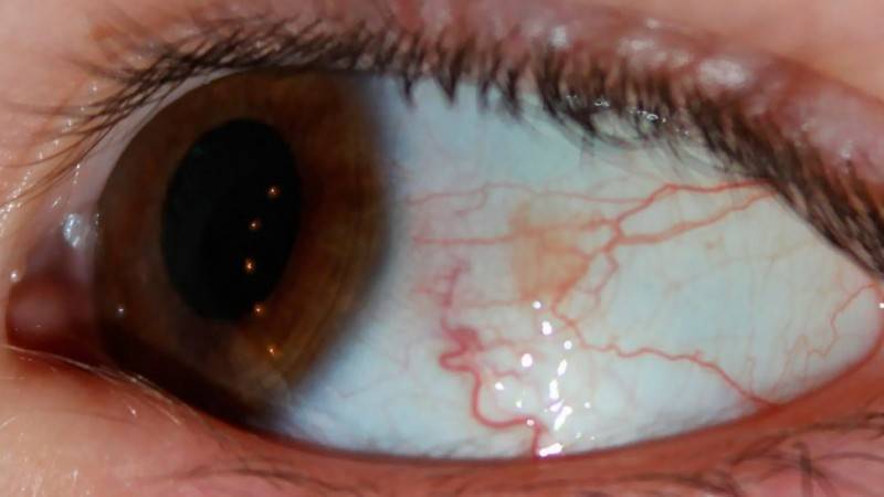 Лопнул капилляр в глазу: причины, симптомы, лечение