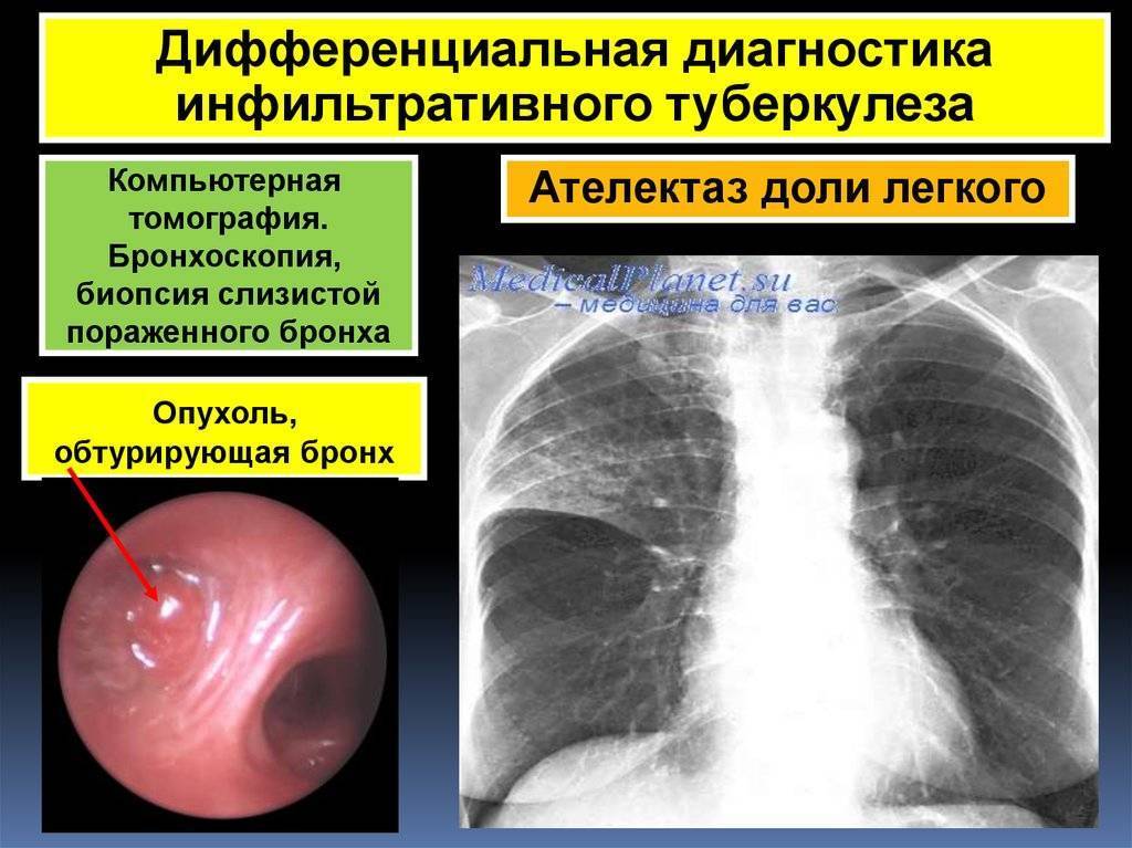 Очаговый и инфильтративный туберкулез презентация