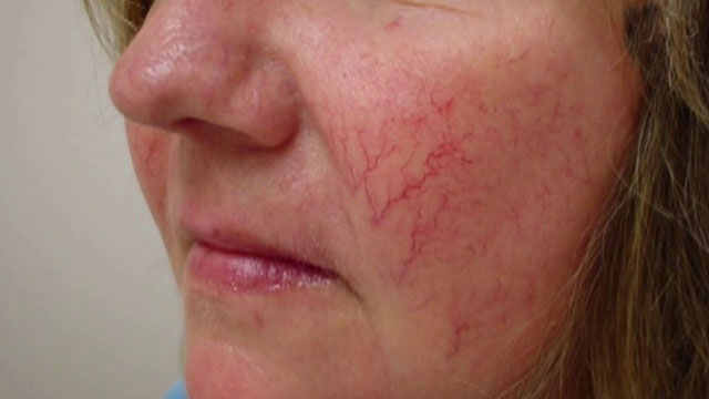 Купероз на лице: причины и лечение, удаление сосудистых звездочек лазером на лице и ногах