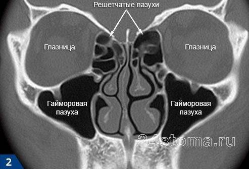 Мр картина сфеноидита