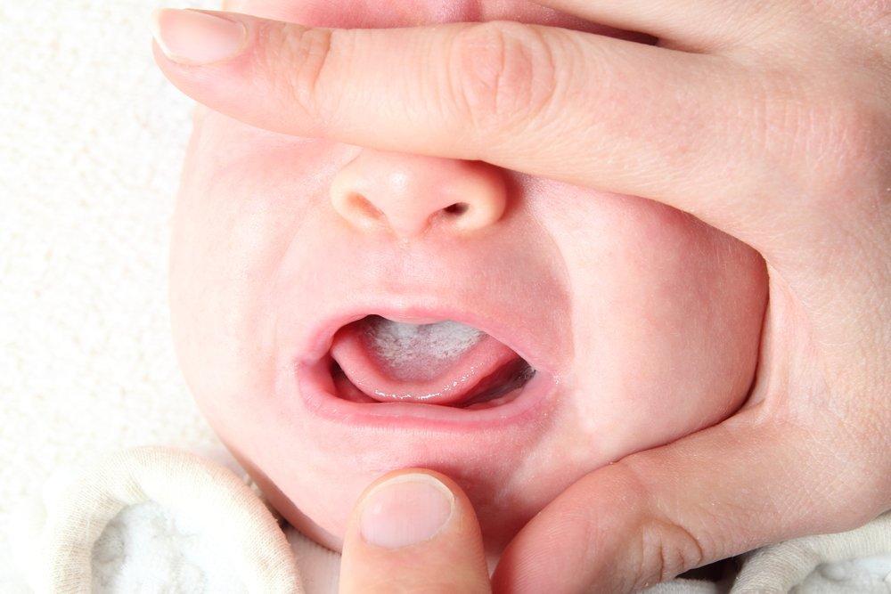 Кандид от молочницы у новорожденных во рту