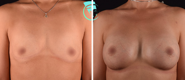Подтяжка грудных желез без имплантов. способы, методы и средства. результаты, фото до и после