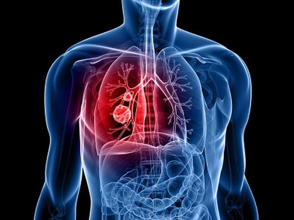 Как отличить туберкулез легких от рака, их сходства и различия