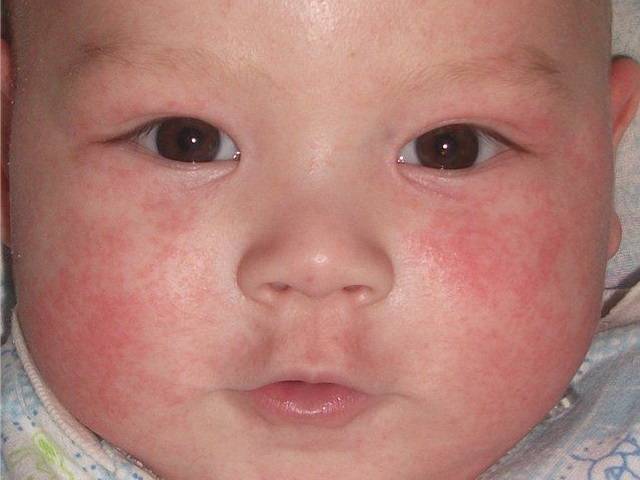 Может ли быть у ребенка аллергия на кабачок? первый прикорм
