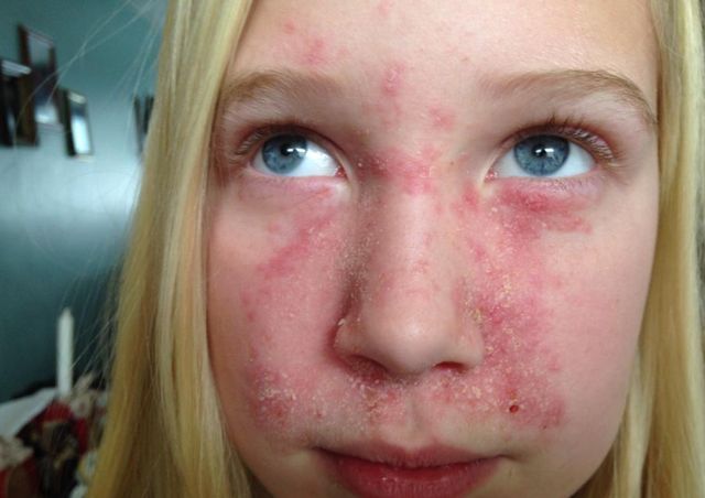 Себорея кожи головы у детей: причины появления и лечение