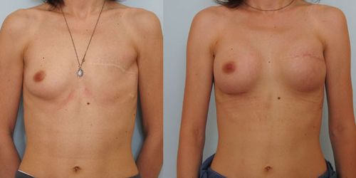 Маммопластика: топ-10 главных вопросов о пластике груди