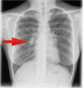 Симптомы, признаки, стадии и формы туберкулеза легких у взрослых
