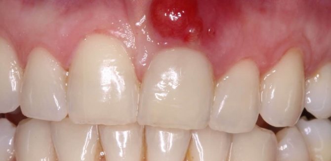 Опасность гранулемы корня зуба и способы лечения