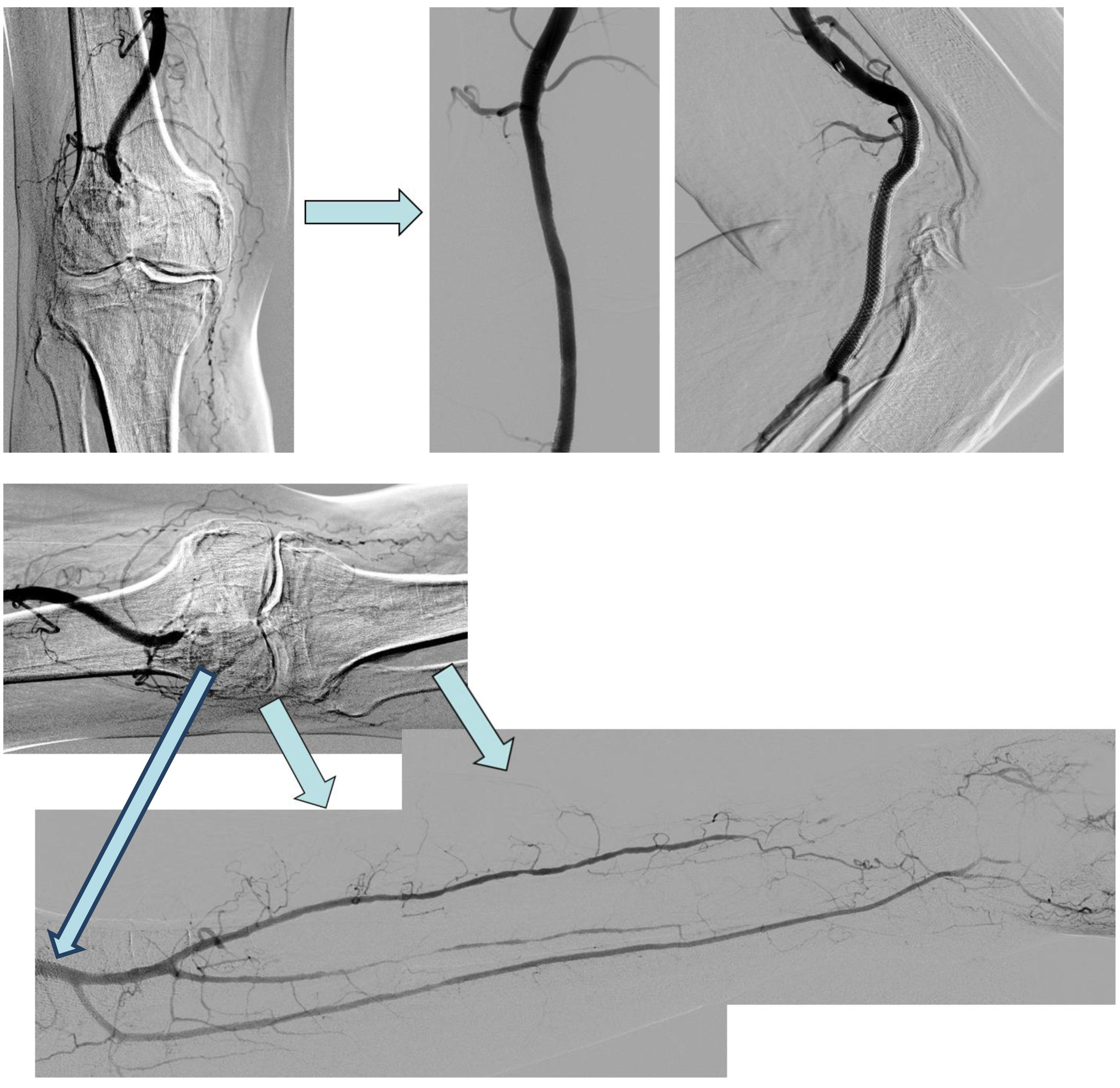 Артерия ноги операция. Облитерирующий атеросклероз вен нижних конечностей. Облитерирующий атеросклероз сосудов нижних конечностей. Атеросклероз сосудов нижних конечностей хирургия. Атеросклероз артерий нижних конечностей операция.