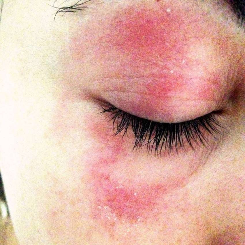 Аллергические высыпания на лице фото