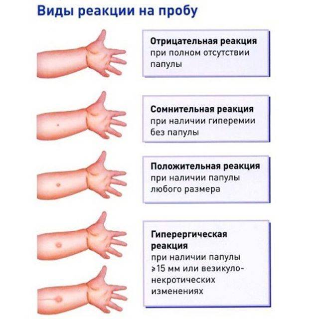 Акдс и полио после манту. - акдс после манту - запись пользователя мария (mary81) в сообществе детские болезни от года до трех в категории прививки - babyblog.ru
