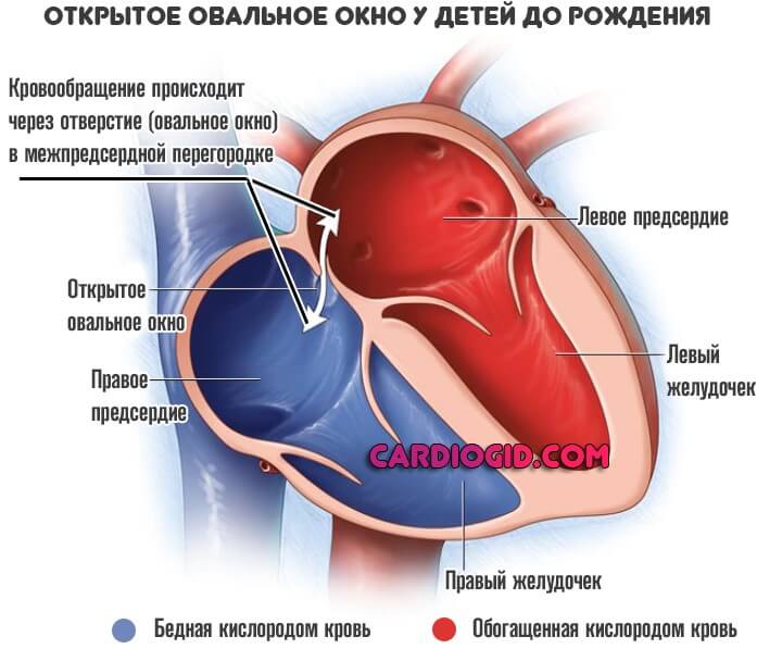 Открытое овальное окно в сердце у ребенка: у грудничка и новорожденного дырка в серце
